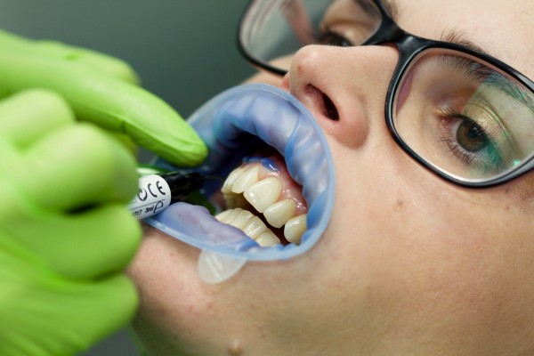 Nanášení ochranné dásňové bariéry