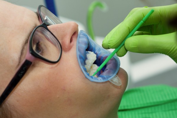 Nanášení bělícího gelu