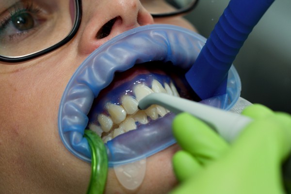 Opláchnutí bělícího gelu