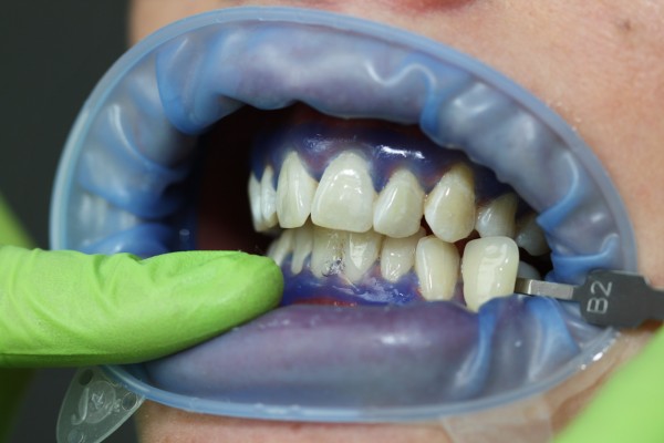 Stanovení koncového odstínu zubů (B2).